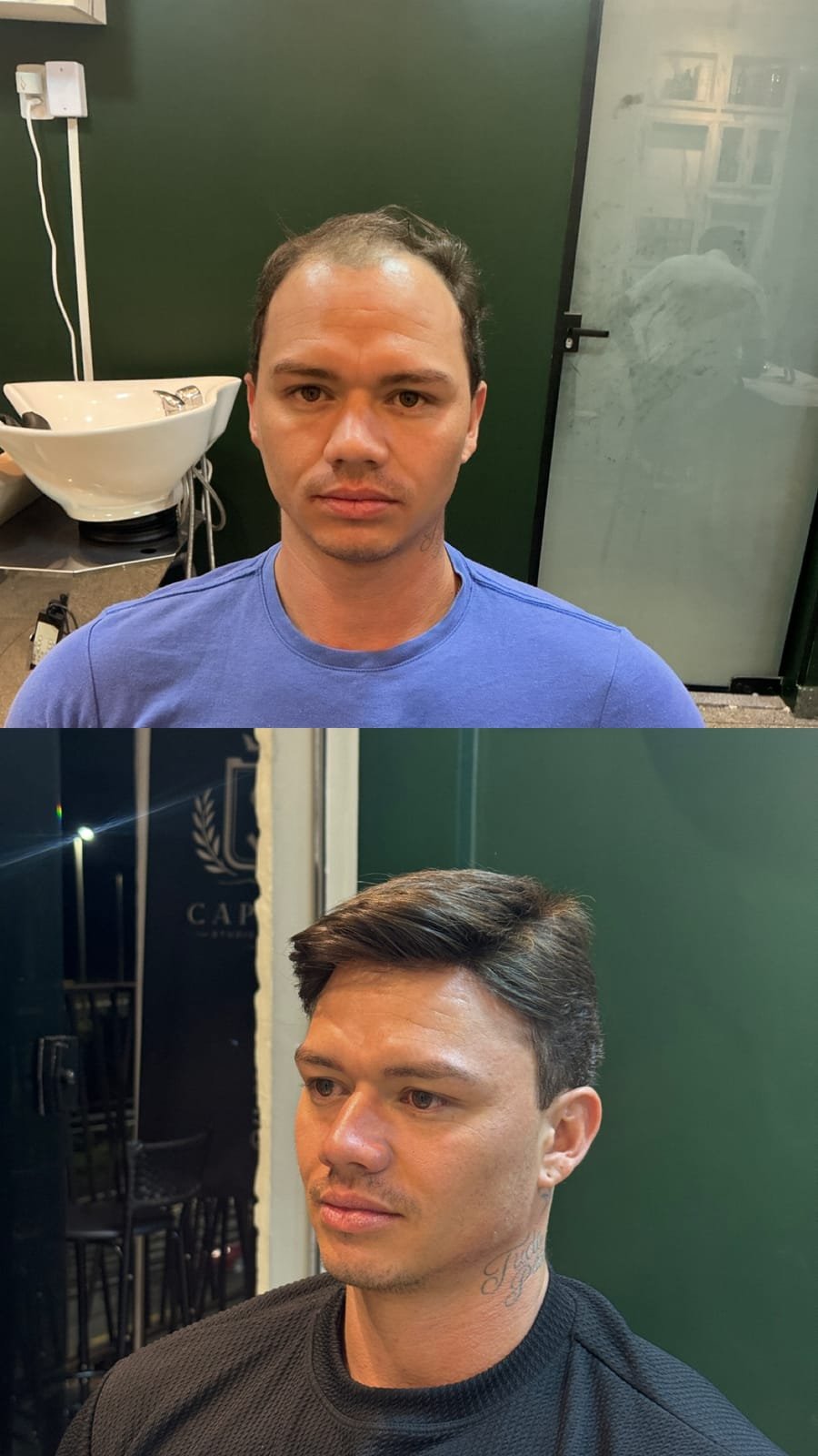 Antes e depois de prótese capilar: topo rarefeito com volume e topete