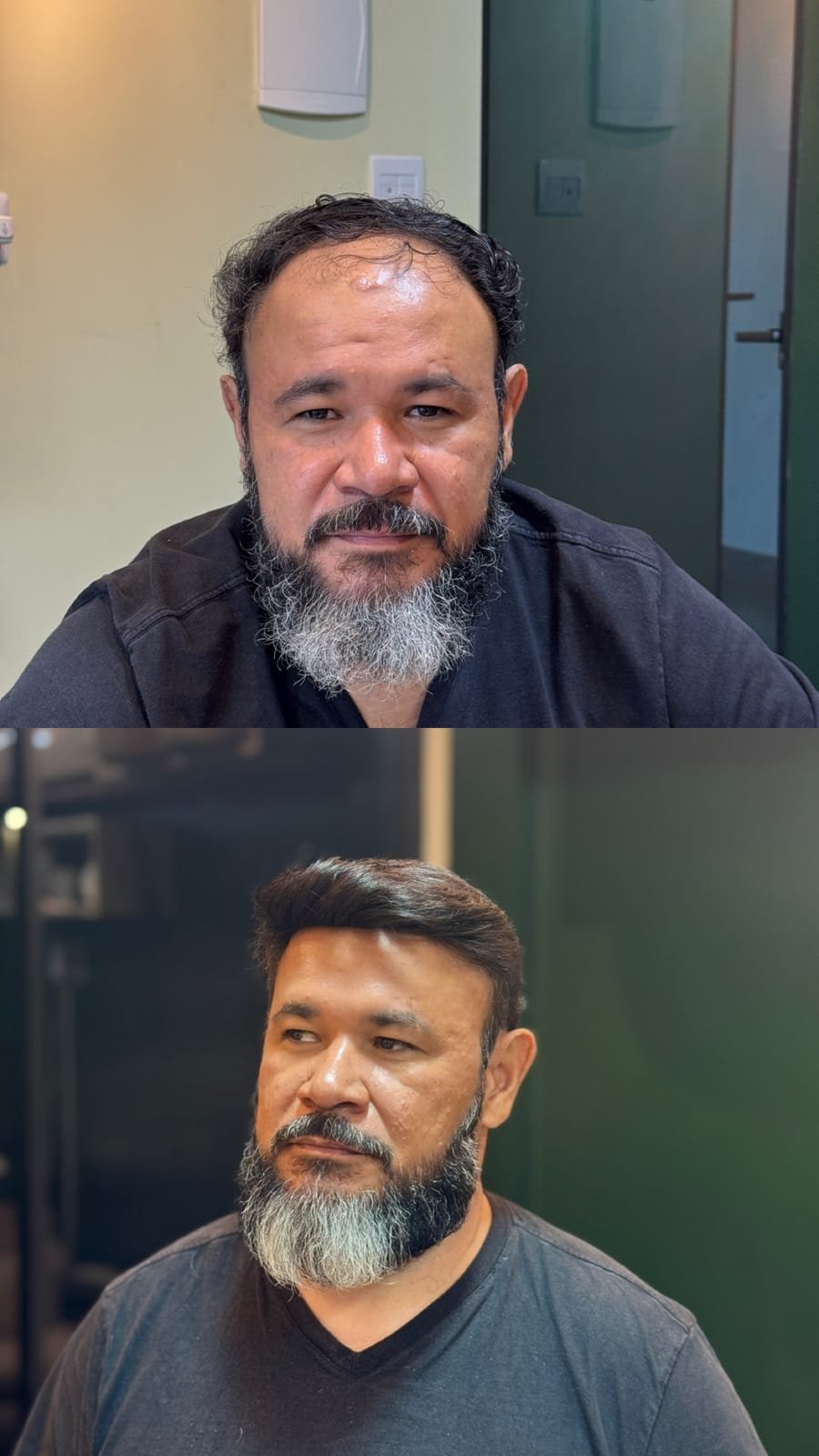 Antes e depois de prótese capilar em cliente grisalho, com barba preservada