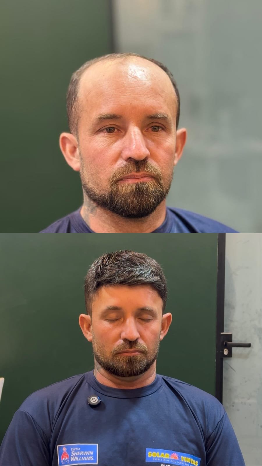 Antes e depois de prótese capilar em calvície avançada, com corte curto